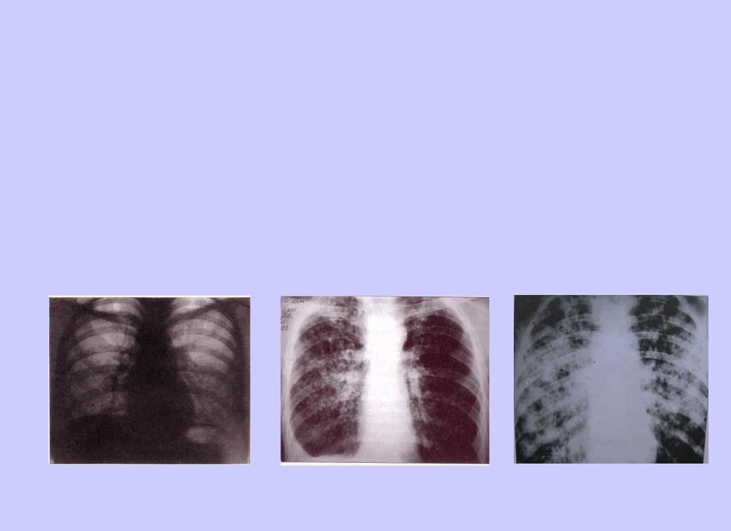 Начальная стадия туберкулеза у взрослых. Ранняя стадия туберкулеза на снимке. Первая стадия туберкулеза. Тяжелая форма туберкулеза. Легкая стадия туберкулеза.