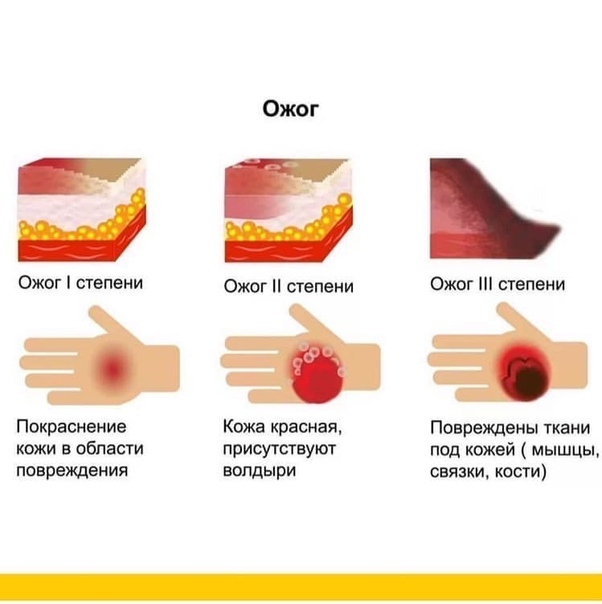 Сильный ожог кипятком фото