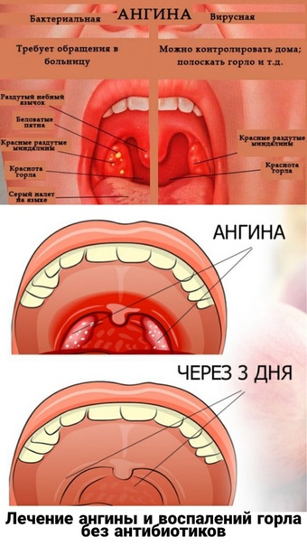 Сыпь температура боль в горле у ребенка. Бактериальная фолликулярная ангина.