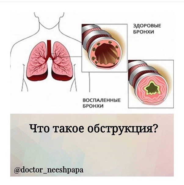 Обструктивный бронхит