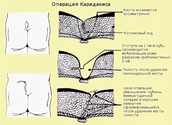 Операция Каридакиса