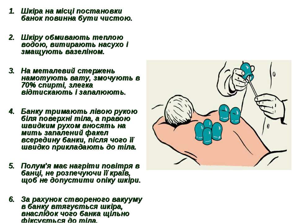 Места постановки банок схема