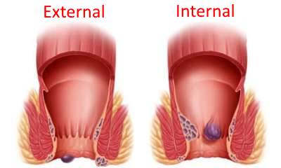 Types of hemorrhoids photos