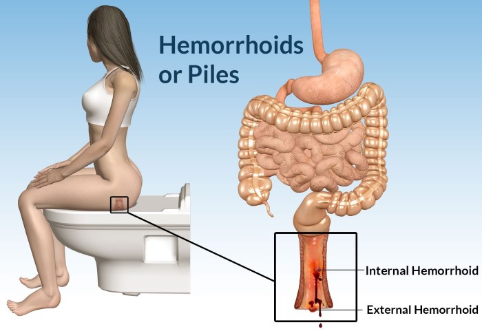 Female hemorrhoids photos