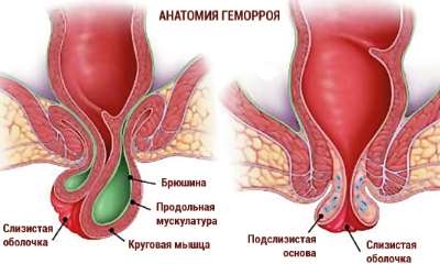 Female hemorrhoids pics