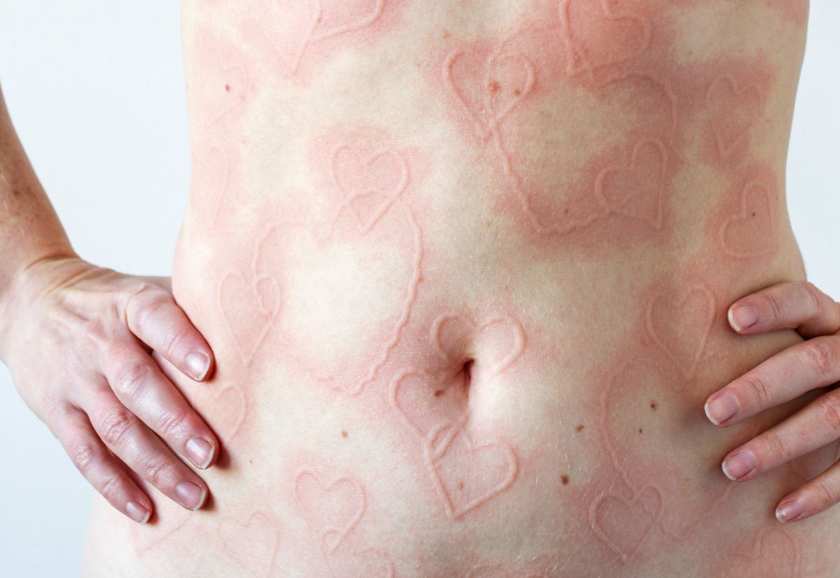 аллергия на груди у беременной фото 103