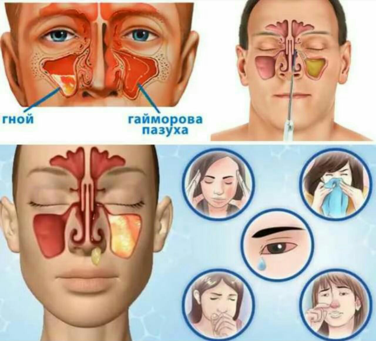 Лор заболевания носа. Гайморит фронтит этмоидит. Носовые и гайморовы пазухи. Носовая пазуха и гайморова пазуха.
