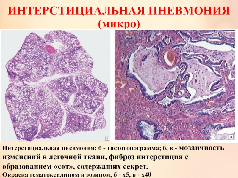 Легочный интерстиций. Межуточное воспаление патанатомия. Неспецифическая интерстициальная пневмония гистология. Хроническая интерстициальная  пневмония гистология. Острая интерстициальная пневмония патанатомия.