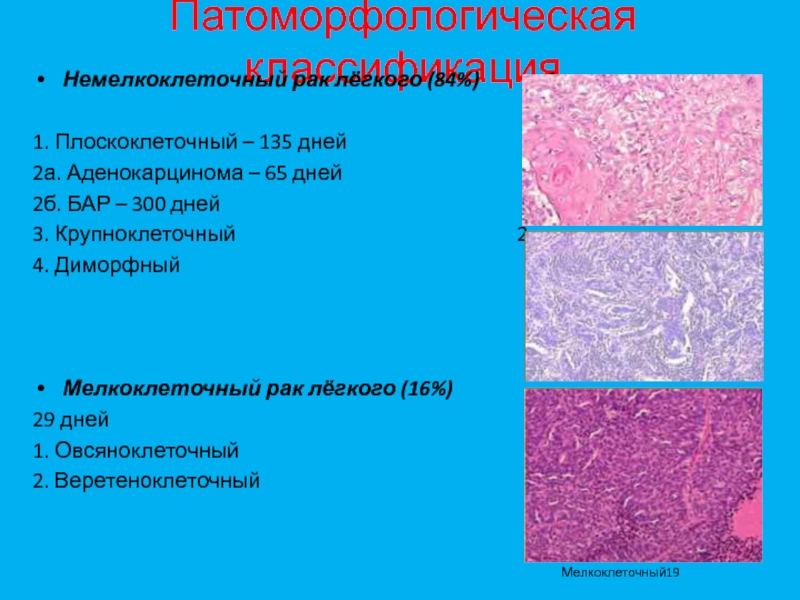 Стадии рака легких плоскоклеточный. Плоскоклеточная карцинома кожи гистология. Плоскоклеточная карцинома легкого гистология. Гистологическая классификация эпителиальных опухолей легкого. Аденокарцинома лёгкого гистология.