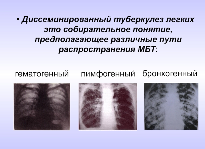 Лимфогенный туберкулез. Лимфогенный диссеминированный туберкулез рентген. Хронический гематогенно диссеминированный туберкулез рентген. Гематогенно-диссеминированный туберкулез легких рентген. Хронический диссеминированный туберкулез рентген.