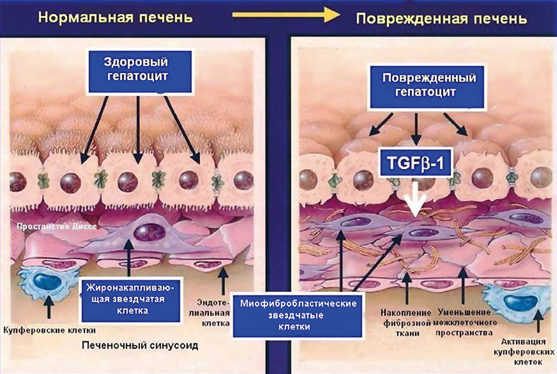 Симптомы фиброза у мужчин. Механизм развития фиброза печени. Патогенез фиброза печени. Разрушение клеток печени. Регенерация клеток печени.