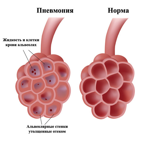 Пневмония