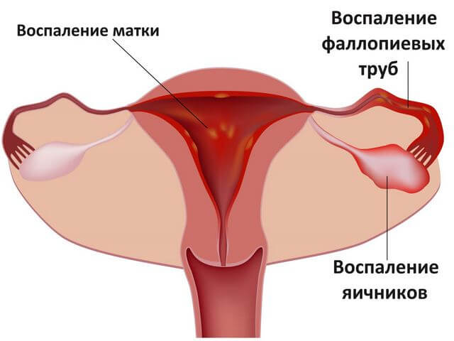 Воспаление женских органов