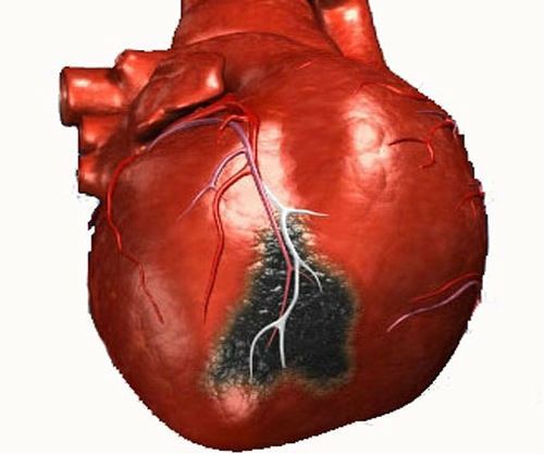 Инфаркт миокарда