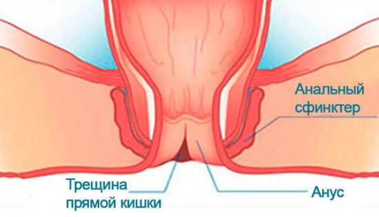 Анальная трещина