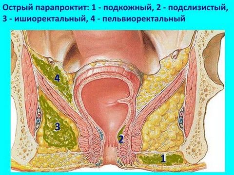 Виды парапроктита