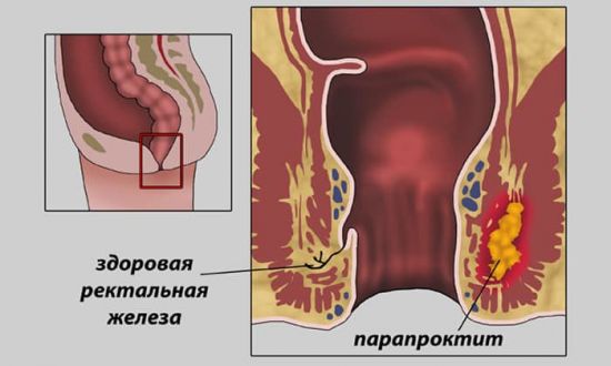 Парапроктит