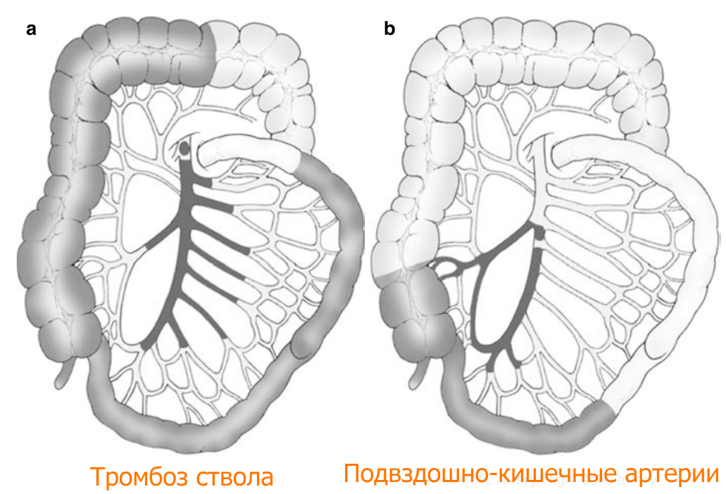 Ишемия кишки