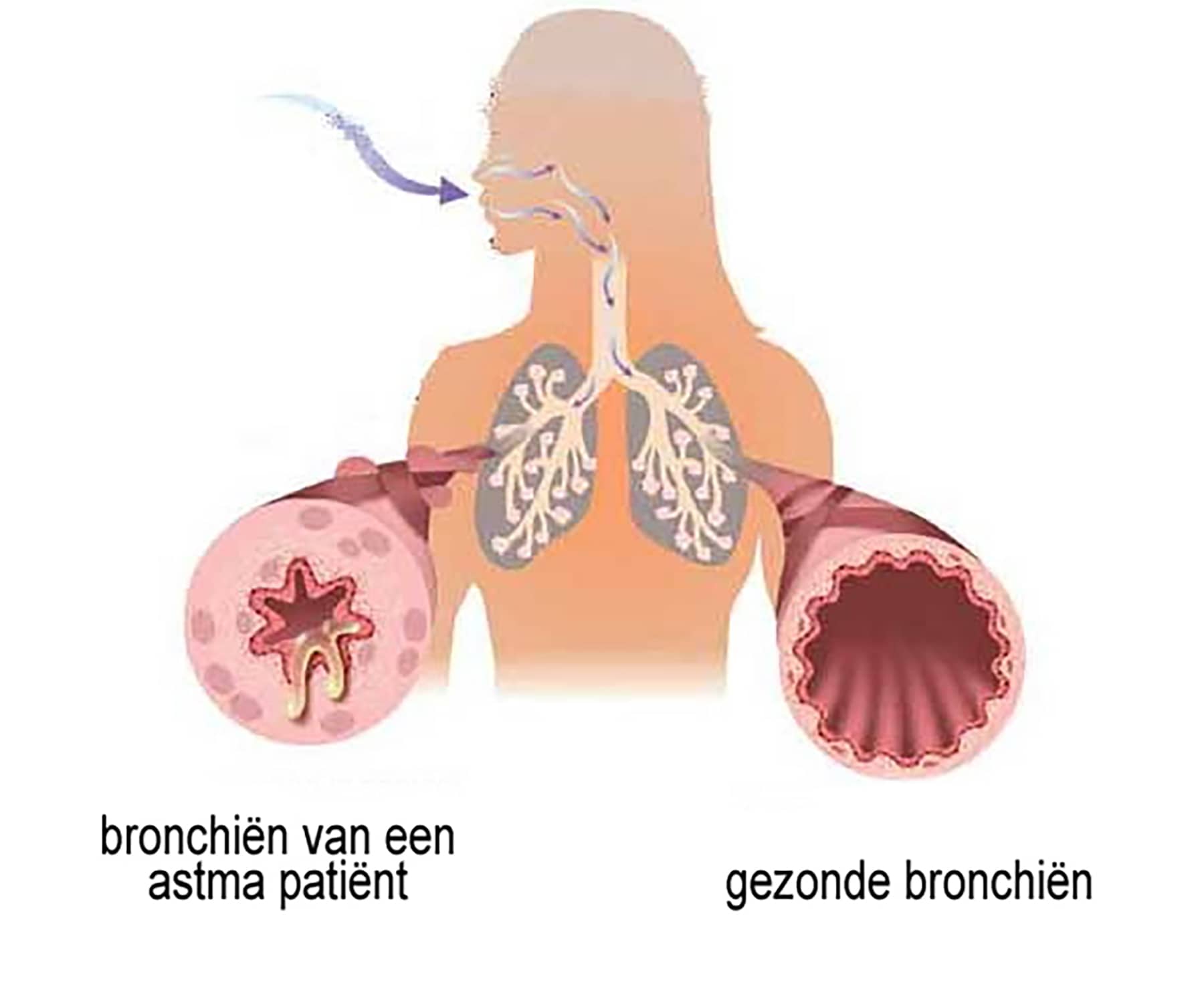 Астма заболевание дыхательных