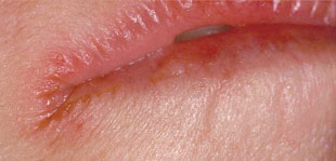 Angular cheilitis