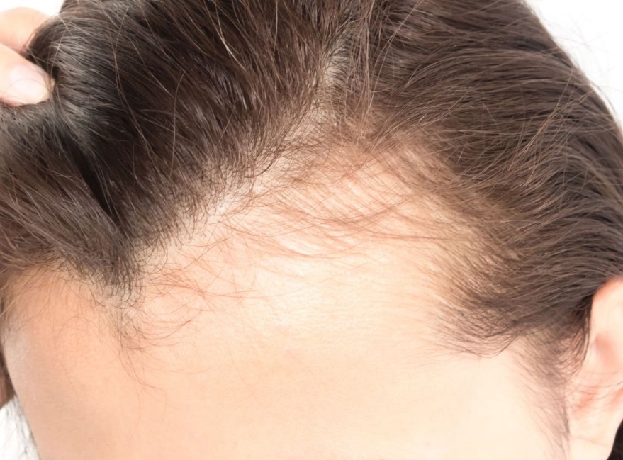 Стали выпадать волосы причины. Витамин д и очаговая алопеция. Сильное выпадение волос у подростка.