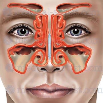 Полисинусит что это такое. Полипозный пансинусит. Атрофический риносинусит. Пансинусит риносинусит. Двусторонний полипозный пансинусит.