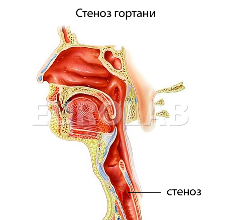 Стеноз гортани