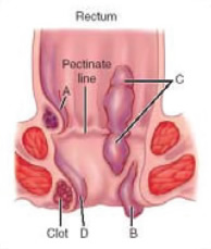 In this figure A represents an internal hemorrhoid, B represents an external prolapsed hemorrhoid, C is a mixed hemorrhoid (both internal and external), D is a thrombosed hemorrhoid and E is an external hemorrhoid.
