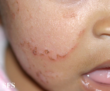 atopic dermatitis baby face