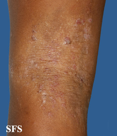 atopic dermatitis limb