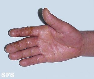 Irritant contact dermatitis on the hand