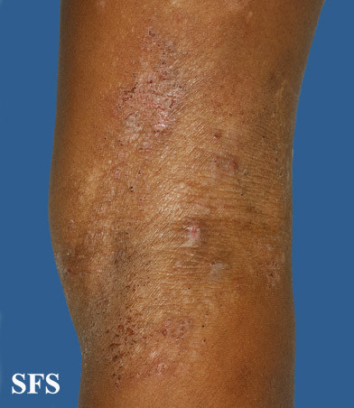 knee eczema