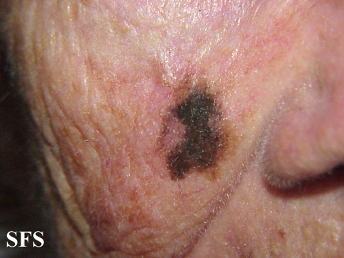 Lentigo maligna - melanoma on the face