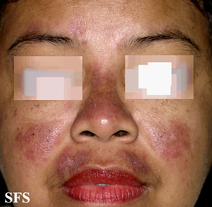 systemic lupus erythematosus - SLE