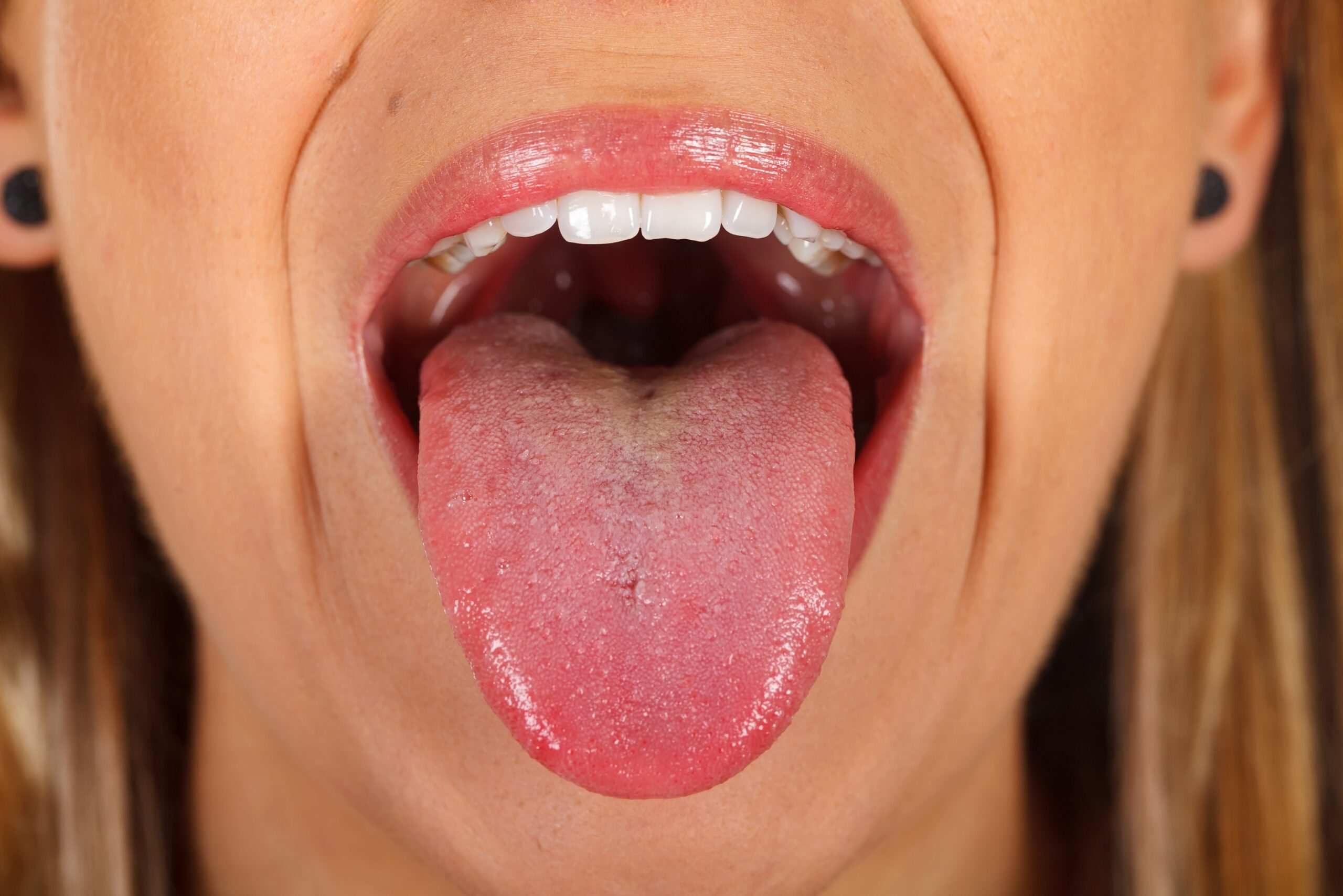 Язык высунутый изо рта. Гипопластический глоссит.