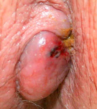 external bleeding hemroids
