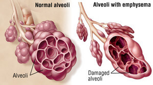 Normal alveoli vs damaged alveoli during emphysema picture