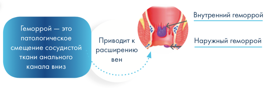 План лечения геморроя