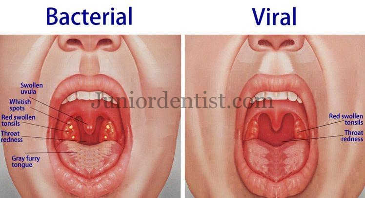 Difference between bacterial and viral tonsillitis