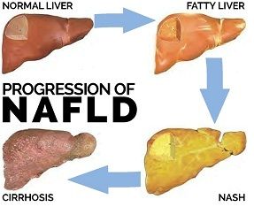 Image demonstrating the progression of fatty liver disease