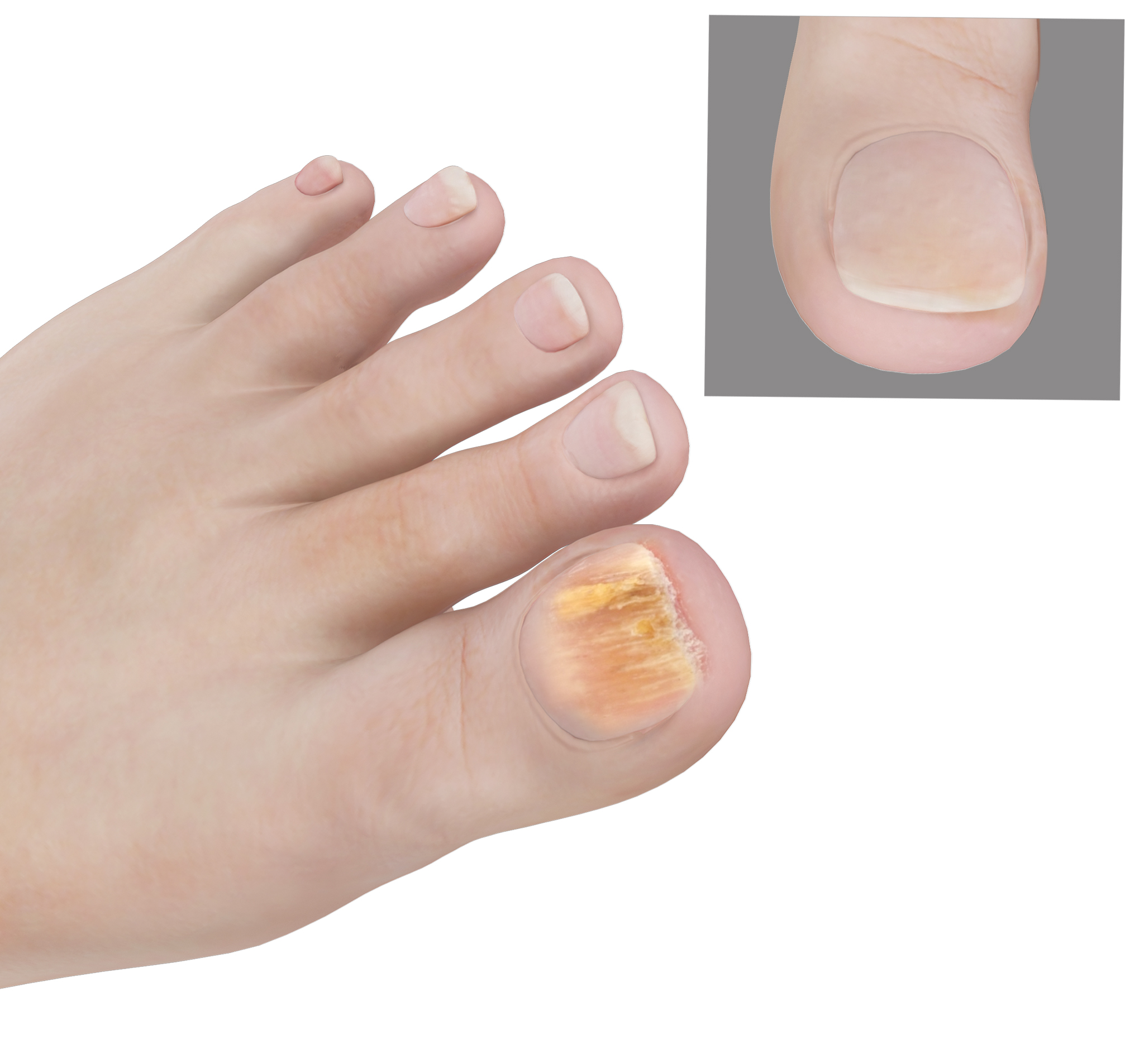 Лечение ногтевого грибка на ногах. Грибок ногтей онихомикоз. Онихомикоз онихокриптоз. Дерматофитного онихомикоз.