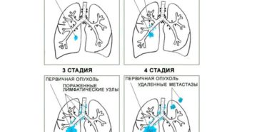 Химиотерапия при раке 4 стадии с метастазами