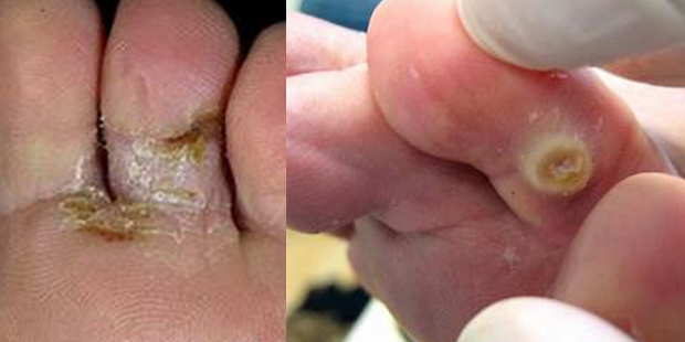 Запущенная стадия микоза между пальцами на ногах