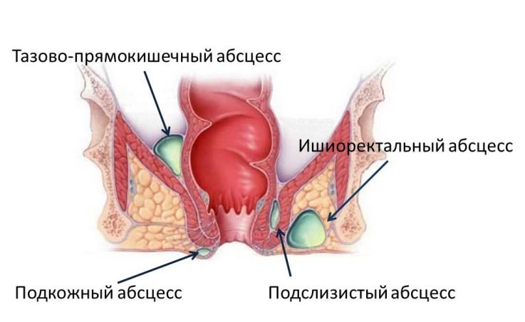 Осложнение геморроя 